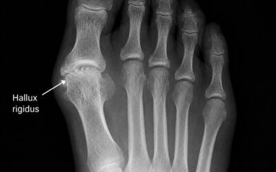 L’Hallux Rigidus